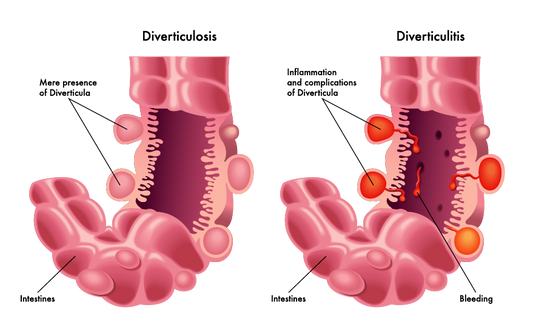 GUT y diverticulitis