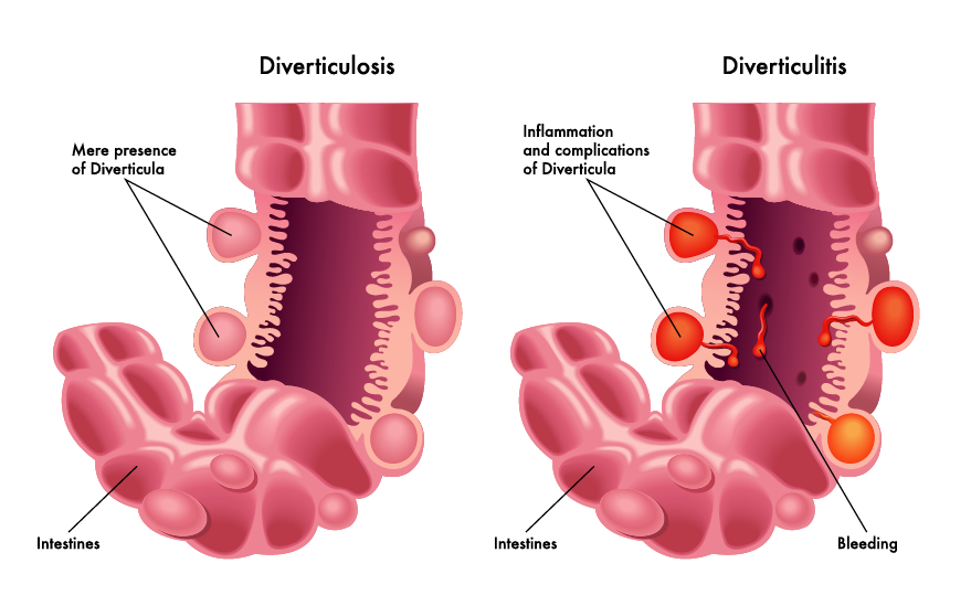 GUT y diverticulitis
